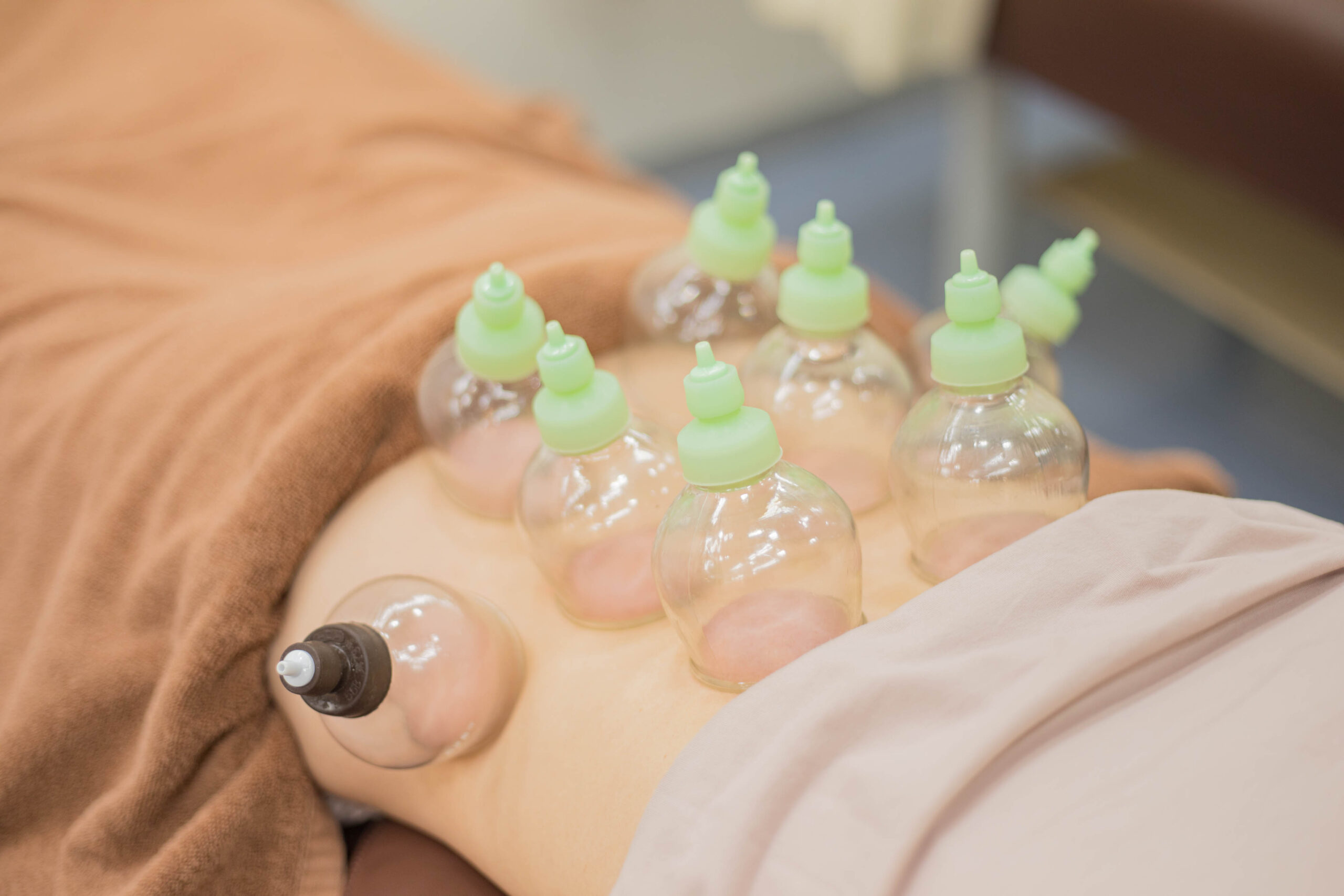 ジェッツ西船整骨院でのカッピング施術の様子